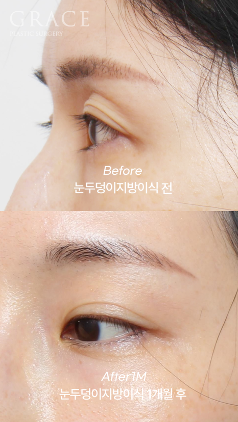 Hollow Eye Holes + Under-Eye Puffiness → (Upper Eyelid Fat Grafting + Fat Repositioning) image 4
