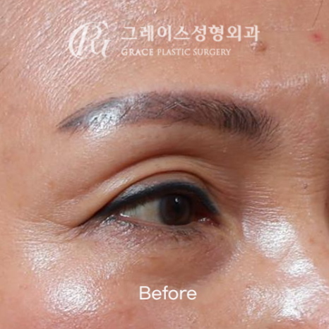 60대 눈꺼풀 고민 상안검 대신 선택한 눈두덩이 지방이식 관련 이미지 1