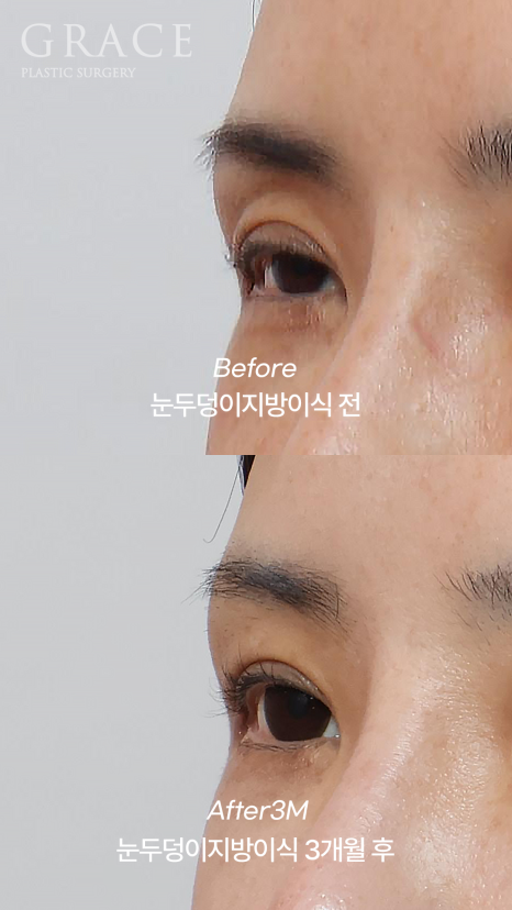 Grace Plastic Surgery 40s Case: Improved Eye-Opening Strength After Upper Eyelid Fat Grafting image 3