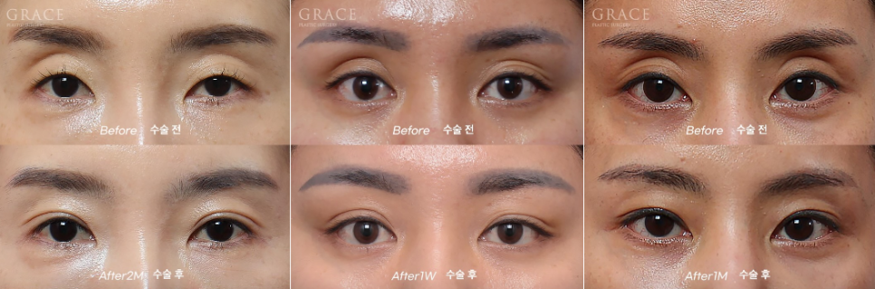 Before and After Eyelid Fat Grafting for Sunken Eye Hollows | Grace Plastic Surgery image 1