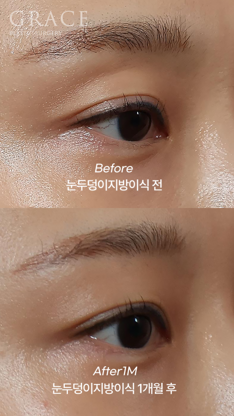 눈두덩이 꺼짐 개선을 위한 지방이식 관련 이미지 6