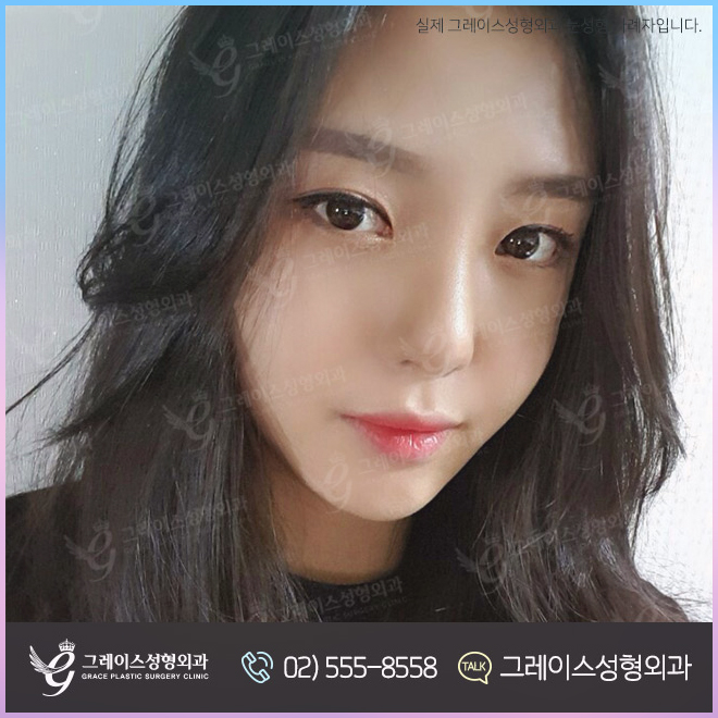 눈앞트임비용 이렇게 알아보세요 관련 이미지 6