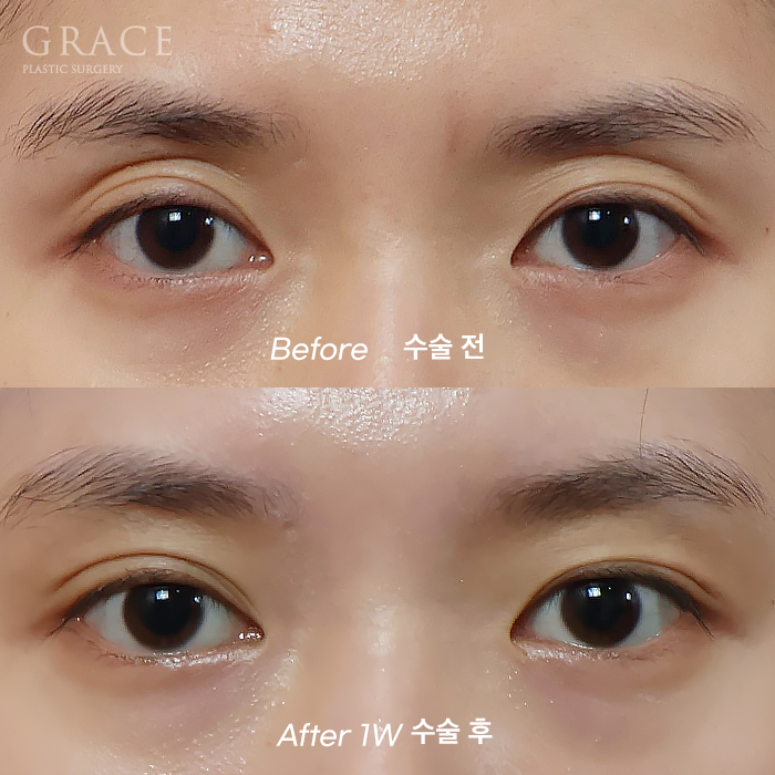 Recovery Timeline Before and After Eyelid Orbital Fat Grafting: 1 Week image 1