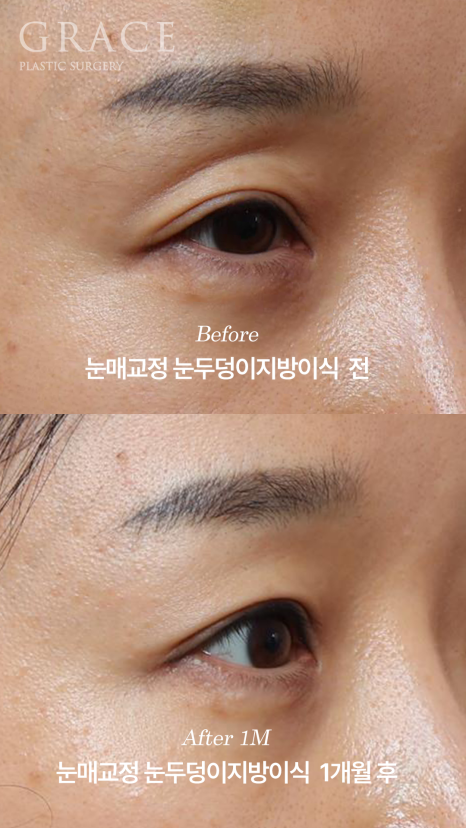 눈성형 부작용 후 재수술 안검하수 교정과 눈두덩이지방이식 1개월 경과 관련 이미지 5