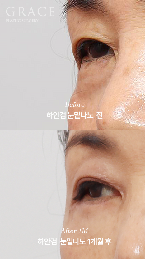 Side Effects of Under-Eye Fat Repositioning? Common Traits of People Who Say It Went Wrong image 5