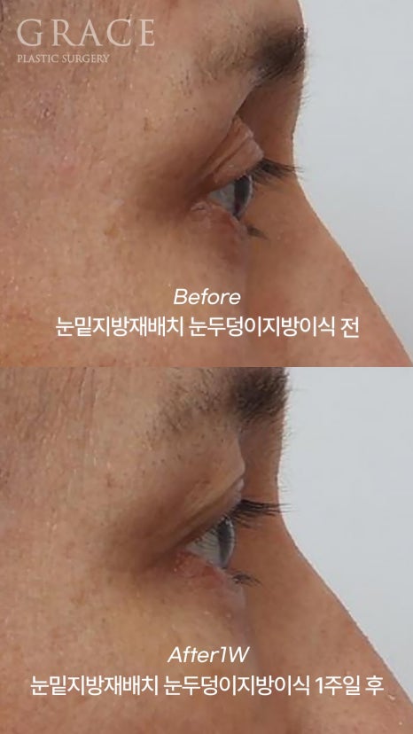 Eyebrow Hollow Fat Grafting Before and After Comparison – Gently Filling Sunken Eyes image 10
