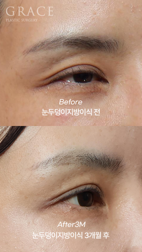 Grace Plastic Surgery 40s Case: Improved Eye-Opening Strength After Upper Eyelid Fat Grafting image 7