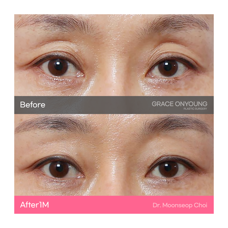 Eyelid Fat Grafting (Sunken Eye Hollowing) image 1