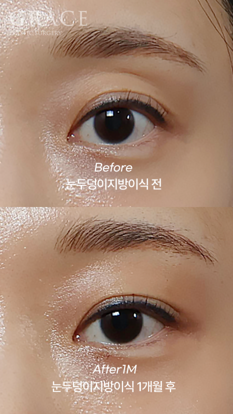 눈두덩이 꺼짐 개선을 위한 지방이식 관련 이미지 1