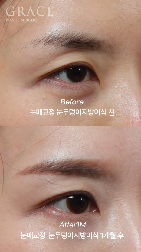 눈두덩이 지방이식 같은 내 지방인데 왜 울퉁불퉁해질까? 지방의 크기부터 다르니깐 관련 이미지 13