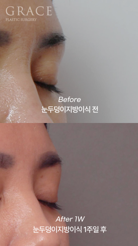 Before and After: Eyelid Fat Grafting Maintained for Over 2 Years in My Late 30s image 6