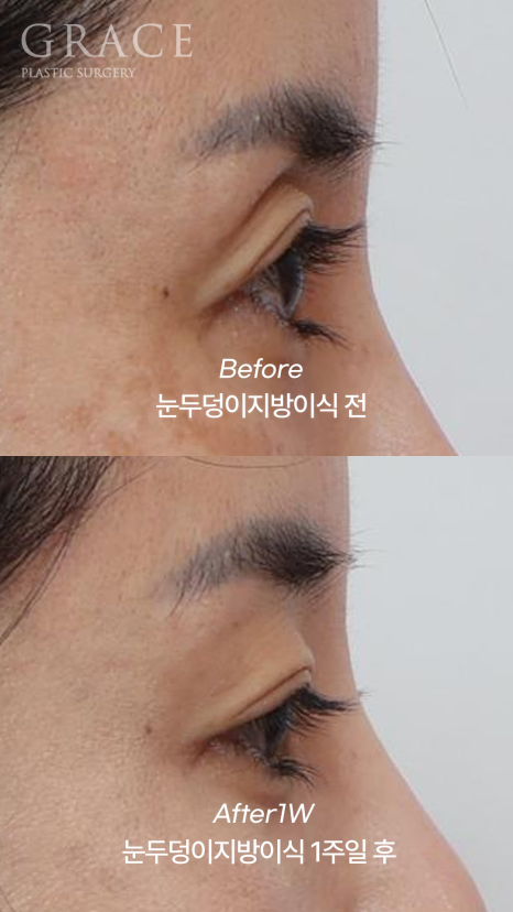 Week 1 After Upper Eyelid Fat Grafting in the Mid-40s: A Natural Return Without Swelling image 2