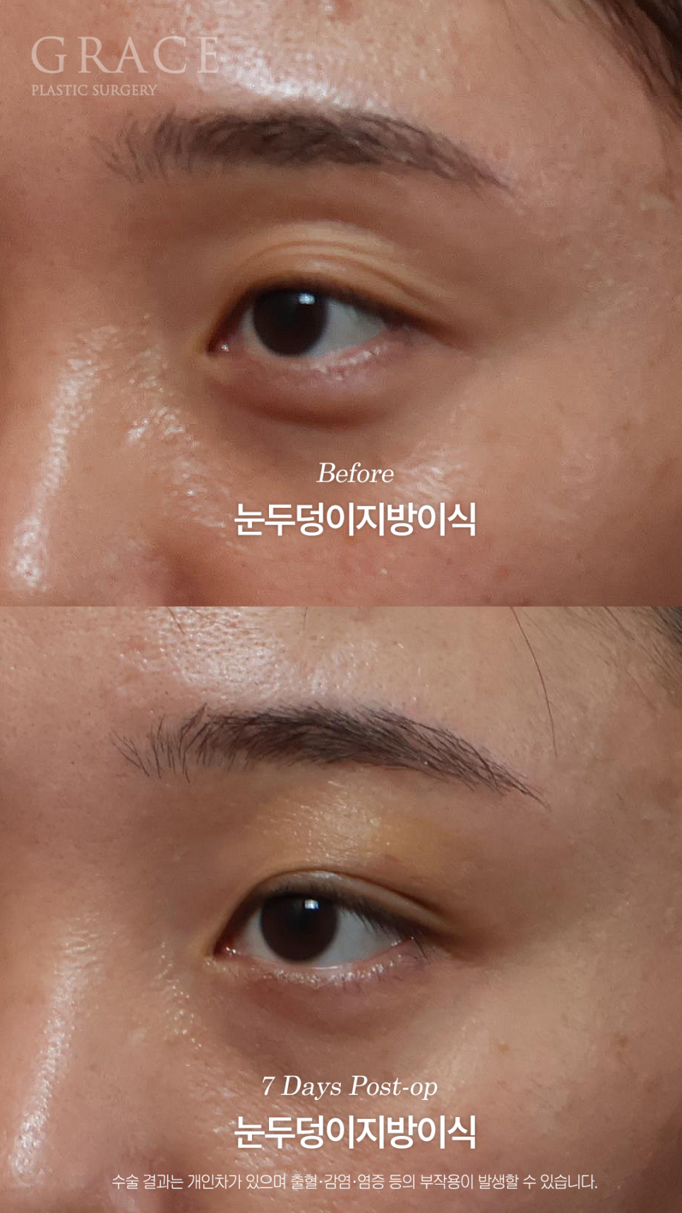 그레이스성형외과 눈두덩이 지방이식으로 채웠는데 눈이 더 잘 떠지는 이유 관련 이미지 5