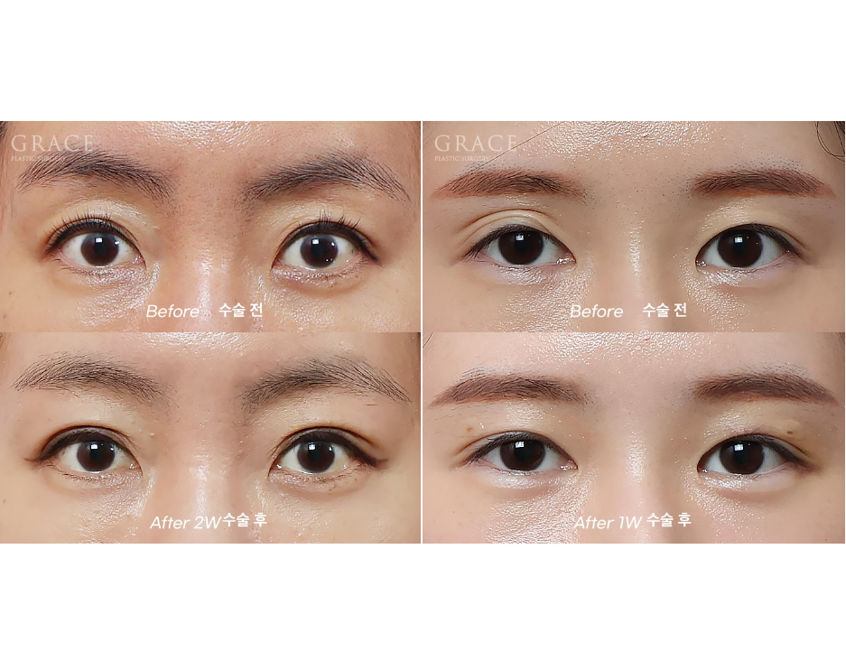 Grace Plastic Surgery Sunken Eye Hollows Upper Eyelid Fat Grafting image 5