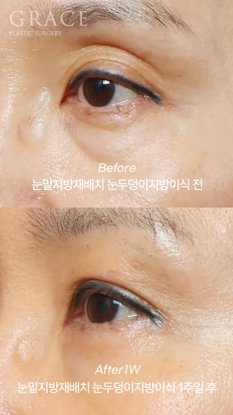 아이홀 꺼짐과 눈밑 지방을 동시에 해결하고 싶다면 관련 이미지 4