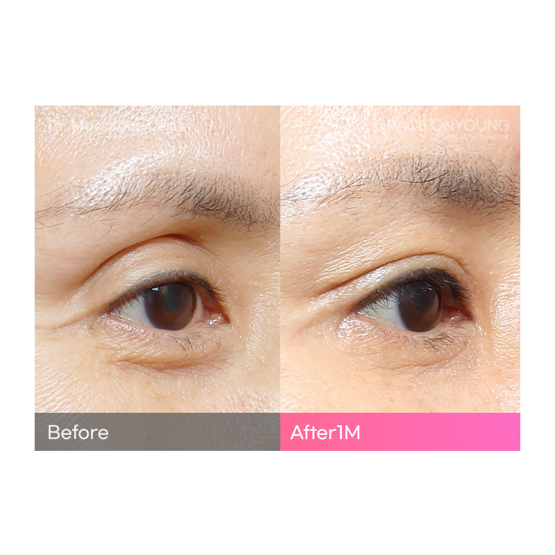Are You Considering Fat Grafting for Hollow Upper Eyelids? image 2
