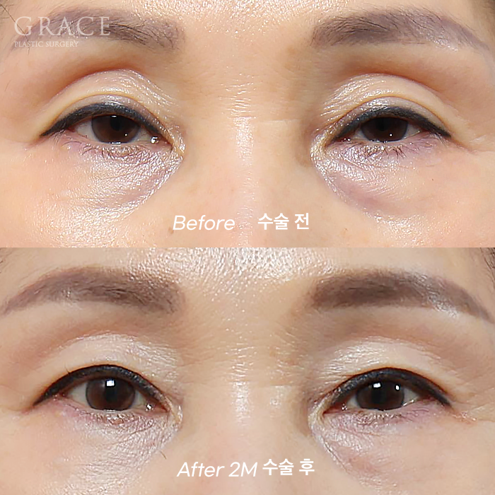 In Your 50s, Restoring a Youthful Look with Before-and-After Eye Surgery and Fat Grafting to the Upper Eyelids, Temples, Under-Eyes, and Above the Brows image 1