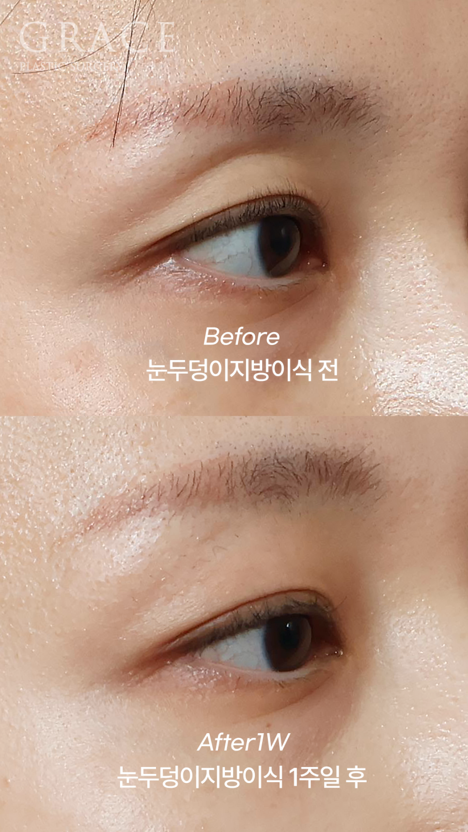 Sunken Eyelid Fat Grafting: Swelling After 1 Week Before & After image 7