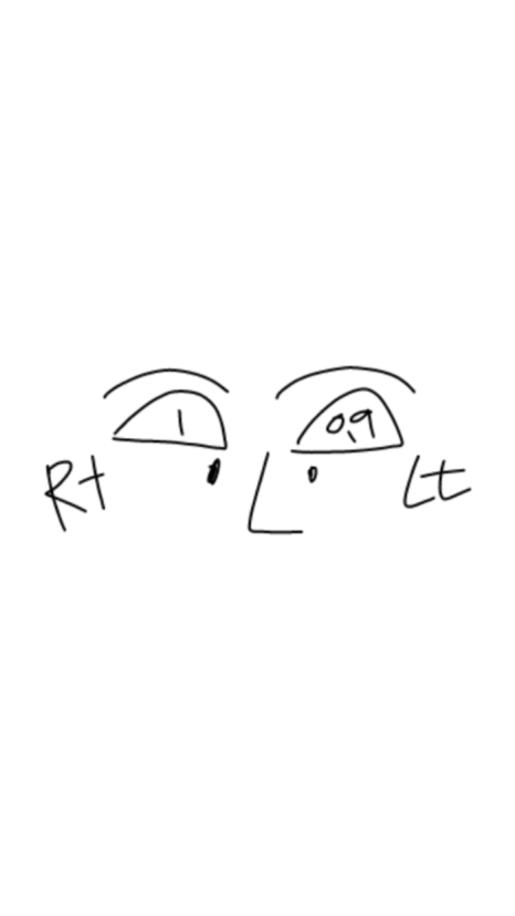 눈 감았을 때 울퉁불퉁? 실제 눈두덩이지방이식 전후 관련 이미지 2