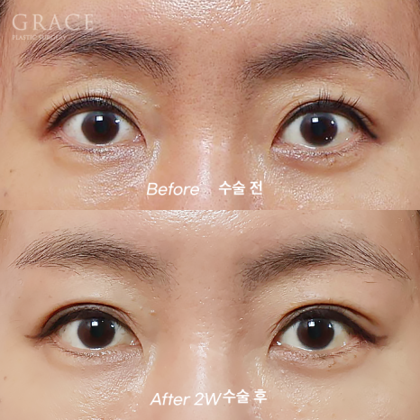 눈꺼풀지 방이식 심하게 꺼진 40대 눈 위 7일 만에 얼마나 달라졌을까? (그레이스성형외과 눈두덩이지방이식) 관련 이미지 4