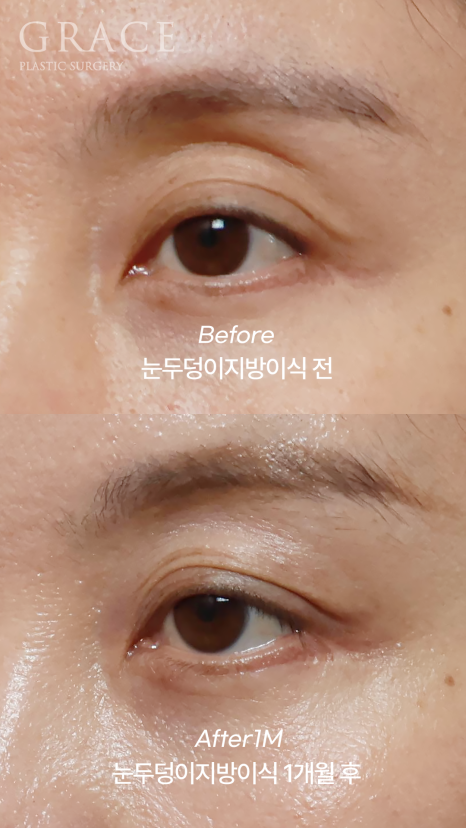 눈꺼풀 지방이식 보법이 다른 최문섭 원장님 실력 관련 이미지 6