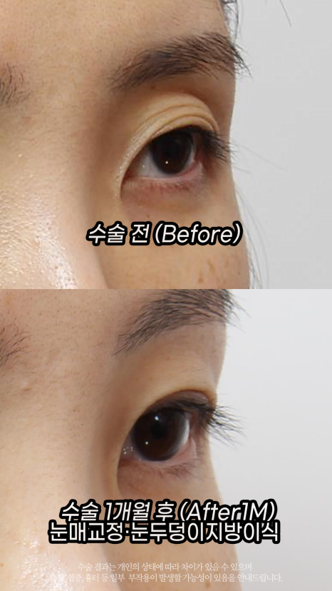 If Sunken Eyelids Are Left Untreated, About Hollows in the Eye-Hole Area (Fat Grafting) image 3