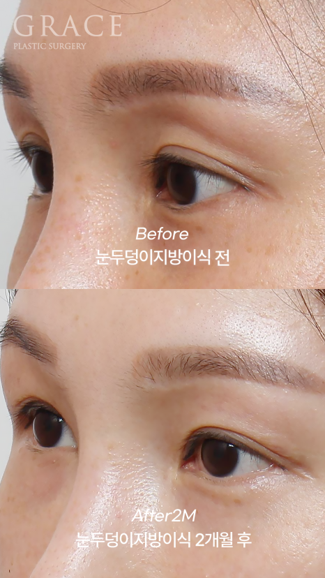 눈두덩이 지방이식 후 광명찾다?... 관련 이미지 3