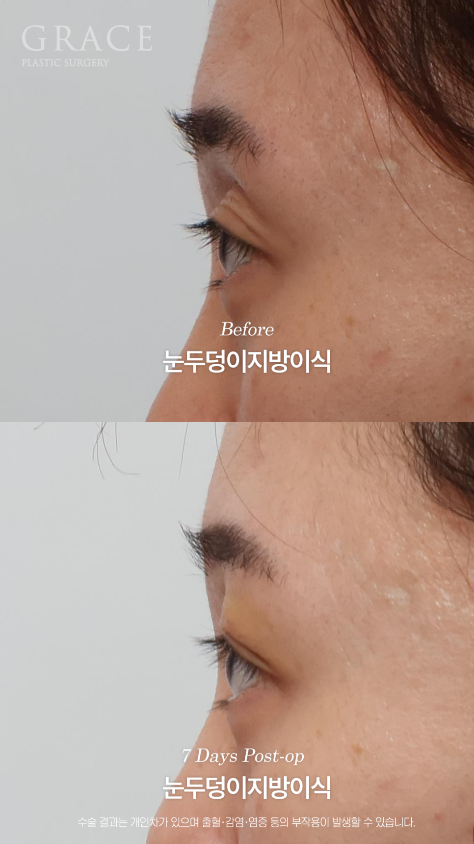 그레이스성형외과 눈두덩이 지방이식으로 채웠는데 눈이 더 잘 떠지는 이유 관련 이미지 9