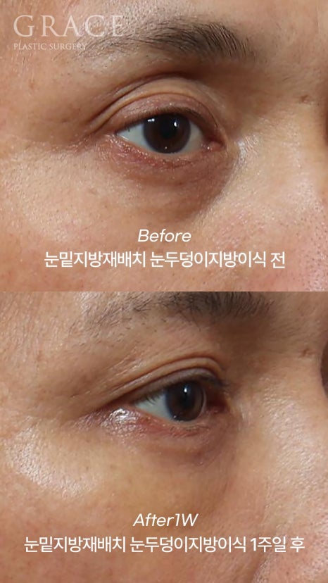 Eyebrow Hollow Fat Grafting Before and After Comparison – Gently Filling Sunken Eyes image 12