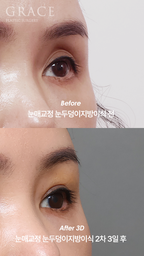 The Key to Improving Sunken Eyelids with Orbital Fat Grafting Is Placement, Not Volume image 8