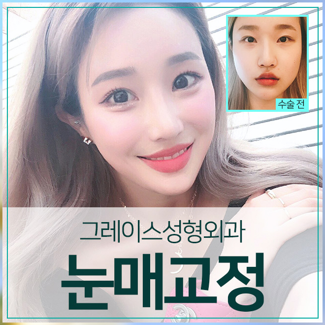 짝눈교정가격 내맘에 들도록 관련 이미지 3