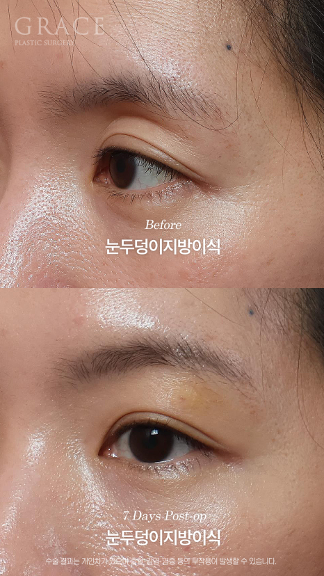 눈두덩이 지방이식 같은 내 지방인데 왜 울퉁불퉁해질까? 지방의 크기부터 다르니깐 관련 이미지 3