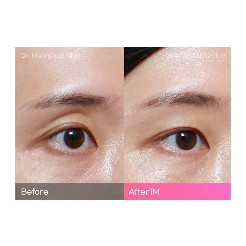 Are You Considering Fat Grafting for Hollow Upper Eyelids? image 4