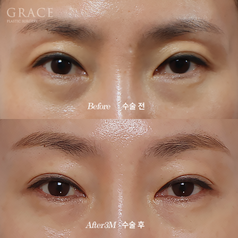 Side Effects of Under-Eye Fat Repositioning? Common Traits of People Who Say It Went Wrong image 8