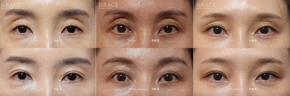 Looking into the Cost of Upper Eyelid Fat Grafting? What Really Matters Is More Than the Price..... image 3