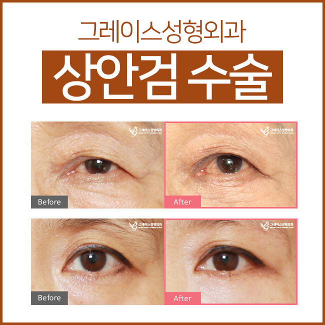 만족스러운 결과! 하안검수술후기 관련 이미지 4