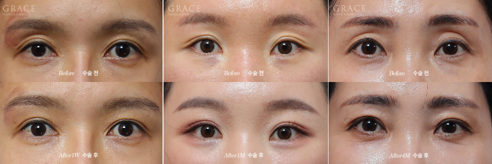 Why Does Fat Grafting to the Upper Eyelids Require a Different Approach from the Lower Eyelids? image 3