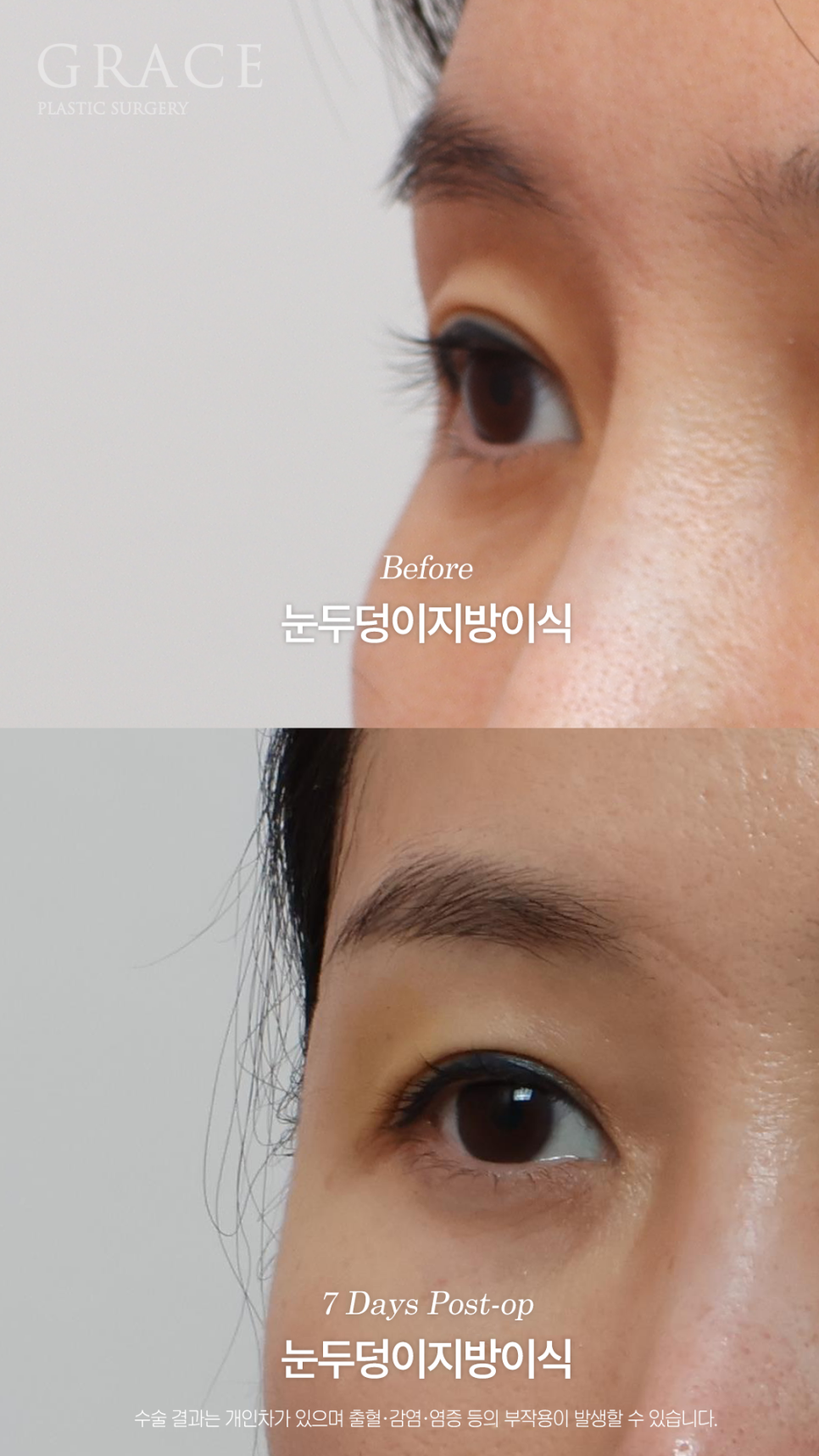 눈두덩이지방이식 하고 일주일 출근 가능한 정도일까? 관련 이미지 7