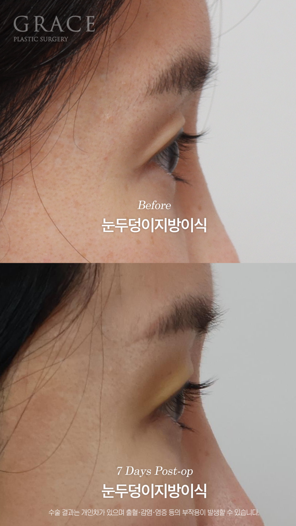 눈두덩이지방이식 하고 일주일 출근 가능한 정도일까? 관련 이미지 8