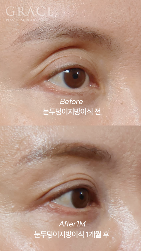 눈꺼풀 지방이식 보법이 다른 최문섭 원장님 실력 관련 이미지 5
