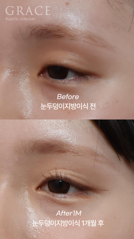 In Your Mid-20s, If You Have Ptosis Before and After Upper Eyelid Fat Grafting, Is Eye Correction Essential? image 7