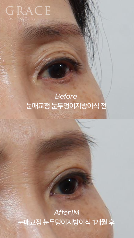 Is Upper Blepharoplasty Necessary at 58? Swelling Side Effects After Non-Incisional Ptosis Correction and Upper Eyelid Fat Grafting image 9