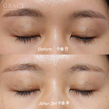 Upper Eyelid Fat Grafting That Shows When You Close Your Eyes? The Cause of Side Effects Is Different image 9