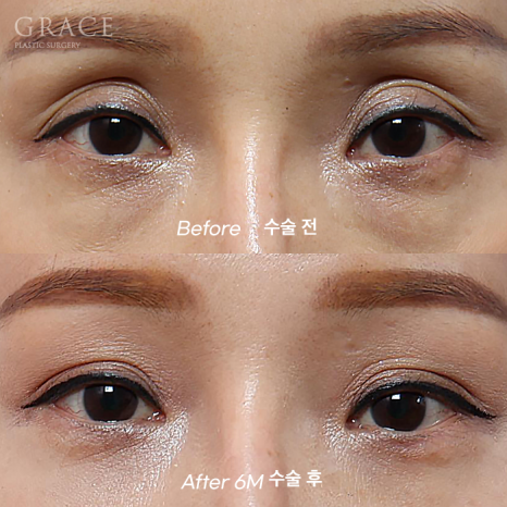 Eye Surgery for People in Their 50s That Reduces Time, Cost, and Recovery: Upper Eyelid Fat Grafting & Under-Eye Fat Repositioning image 3