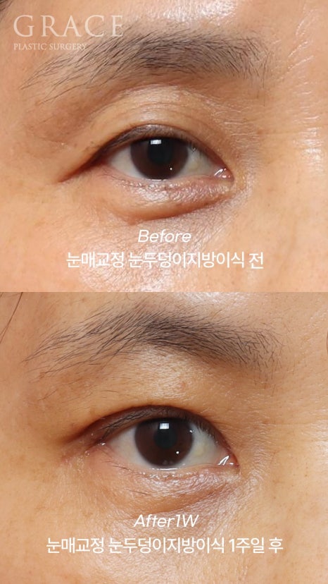 Eyebrow Hollow Fat Grafting Before and After Comparison – Gently Filling Sunken Eyes image 13