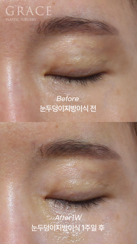 눈두덩이 지방이식 or 풀페이스 지방이식 유지기간&middot;부작용까지 정리 관련 이미지 4