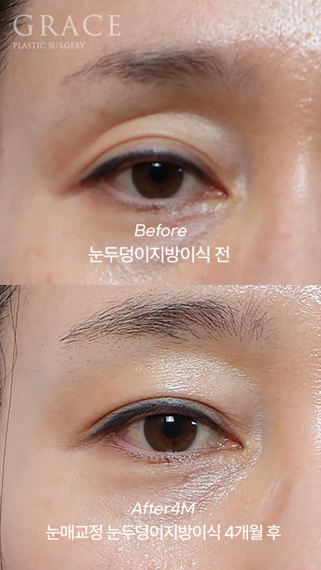 Why Injecting Fat Into the “Orbital Fat” Is Important in Sunken Eye Fat Grafting (dr.essay) image 7