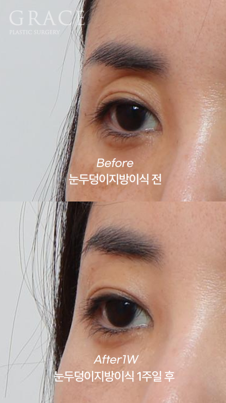 Week 1 After Upper Eyelid Fat Grafting in the Mid-40s: A Natural Return Without Swelling image 10