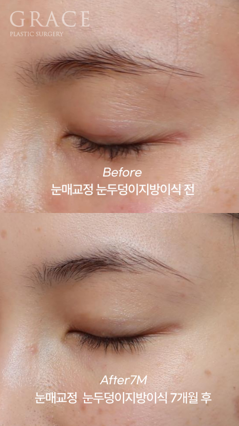 [20대 후반 눈꺼풀 지방이식+눈매교정]  7개월 후 유지력 이렇게 좋을 일? 관련 이미지 7
