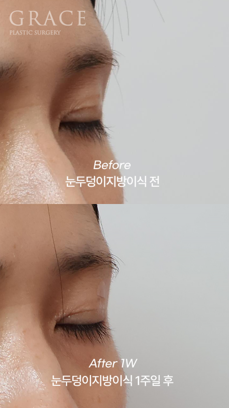 눈꺼풀 지방이식 눈 감았을 때 울퉁불퉁하지 않는 이유 전후사례로 보여드립니다 관련 이미지 7